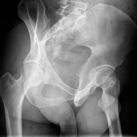 X-Ray Both Hip Oblique View